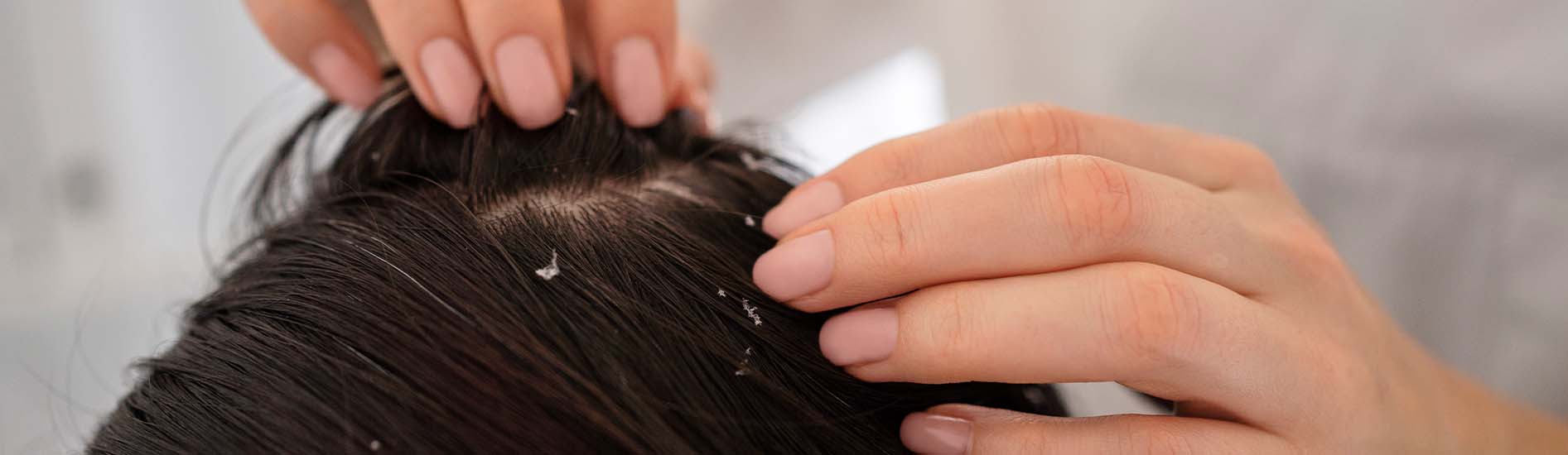 Oily Scalp vs Dandruff in Summer